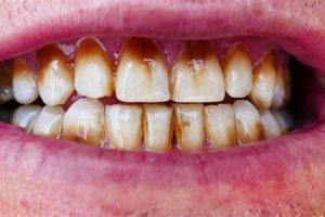 Coffee Info: How to Remove Coffee Stains From Teeth Fast Safem Fabrication - Precision Engineering & Custom Manufacturing Solutions Coffee Info: How to Remove Coffee Stains From Teeth Fast | Safem Fabrication - Precision Engineering & Custom Manufacturing Solutions
